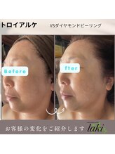 リラクゼーションサロン ラキ(laki)/V VSダイヤモンドピーリング