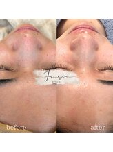 フリージア(Freesia)/ごわつきやくすみはこちらが◎