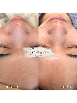 フリージア(Freesia)/ごわつきやくすみはこちらが◎