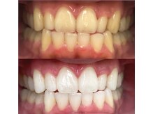 ラブホワイトニング 銀座店(LOVEホワイトニング)/結果が出る ＃ホワイトニング