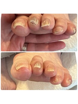 寺子屋ビューティーズ(寺子屋Beauty's)/巻き爪ケア