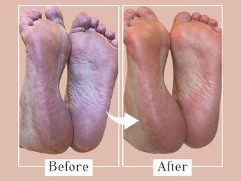 ベベ(Bebe)/40代女性/かかとガサガサお悩み