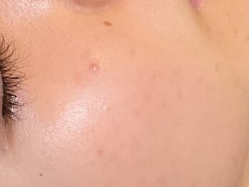 アストリア(ASTORIA)の写真/【鏡を見るのが楽しみに】毛穴ケア黒ずみ・開きを根本改善！