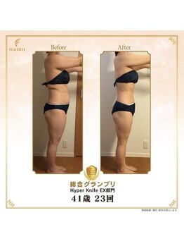 ソル(SOL)/ハイパーナイフシリーズ症例