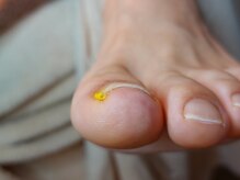 爪切り屋 足楽/保護チューブ◆陥入爪ケア