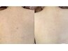 【背中毛穴ケア＆肌荒れ】肌見せの季節☆フォト光ニキビケア＋背中脱毛