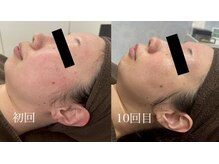 チャマ 高知店(CHAMA)/30代　ララピール　敏感肌の改善