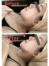 アヤ(aya)/90分小顔× cavi(担当Mizuho)