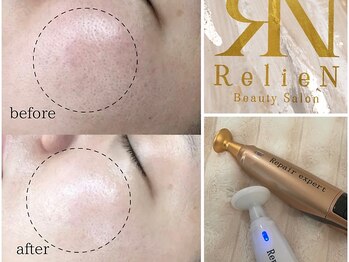 リリアン(RelieN)/プラズマフェイシャル/毛穴洗浄