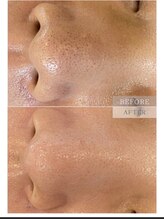 パールブルー(All Perl blue)/韓国技術のエステ