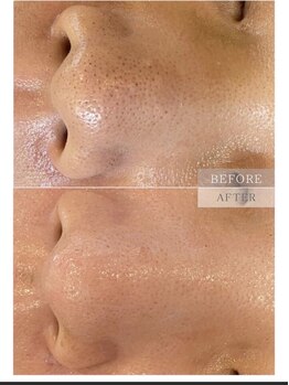 パールブルー(All Perl blue)/韓国技術のエステ