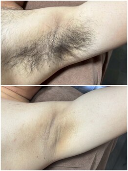 シック 南風原店(Chic)/30代　ワキ脱毛　4ヶ月の経過