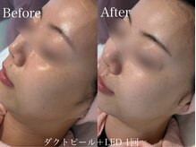 カレンジェビューティー(CarengeBeauty)/ダクトピール＋LED1回