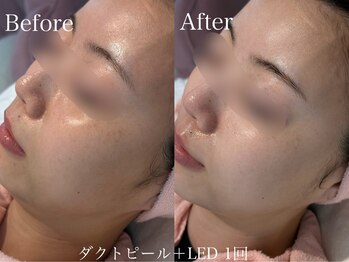 カレンジェビューティー(CarengeBeauty)/ダクトピール+LED1回