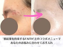 リモア(REMORE.)/徹底肌改善♪