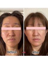 ラ キュート(LA-9TE)/小顔矯正／むくみ／リフトアップ