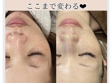 ミリ(MiLi)/しみケア光フェイシャル