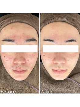 ニキビケア研究所 所沢店/東洋医学×最新美容を組み合わせ