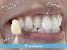 ホワイトニングカフェ 札幌東急百貨店(WhiteningCafe)/◎歯のホワイトニング施術写真◎