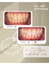 スリール(sourire)/ホワイトニング