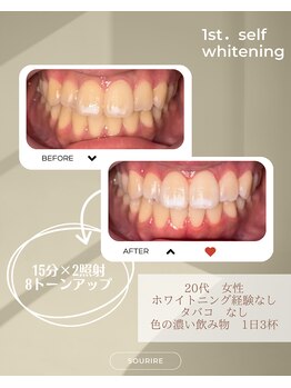 スリール(sourire)/ホワイトニング