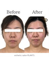 プランツ(PLANTS)/30代／１回／たるみ小顔・首凝り
