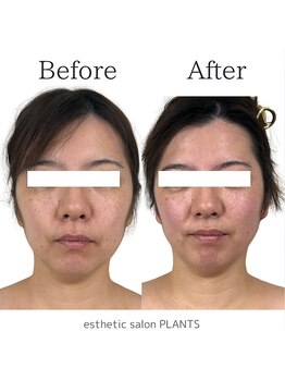 プランツ(PLANTS)/30代／１回／たるみ小顔・首凝り