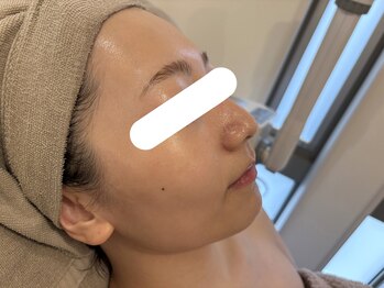 コム(comme39)/afterのお写真★つやんつやん肌