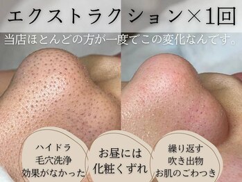 ジプソフィラフィフティドット(gypsophira15.)の写真/都度払い◎【結果重視の毛穴ケア】汚れや詰まりを徹底洗浄！“本気の毛穴ケア”を体験したいあなたに。