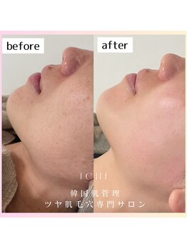 イチ(ichi)/水光肌ハーブピーリング