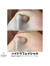 アクシア ビューティー サロン(AXSIA)/【ハイドラ】BeforeAfter