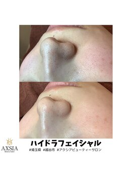 アクシア ビューティー サロン(AXSIA)/【ハイドラ】BeforeAfter