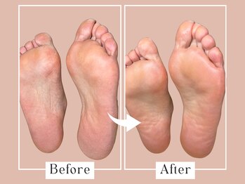 ベベ(Bebe)/女性/皮めくれ・カサカサお悩み