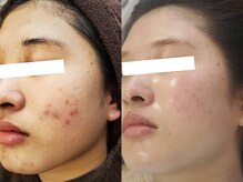肌荒れや赤みでお悩みの方へ、真の結果を約束する肌改善専門店の熱いこだわり