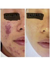 ダリア(DALIA)/しつこいニキビのケア