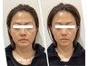 【たるみ・むくみスッキリ】-5歳若見え◇小顔矯正