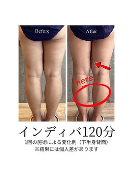 サクランボ(SAKURAMBO)/ 痩身インディバxNONFエナジー1