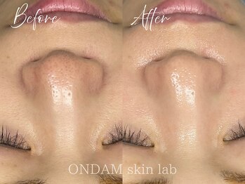 オンダム 南青山 表参道(ONDAM)/【毛穴の黒ずみ・開き】