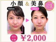 ラプリアンジュ 鹿児島天文館店(Raplit ange)/隆鼻＋輪郭矯正40分10回