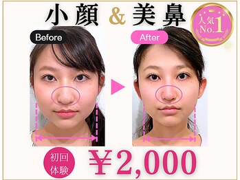 ラプリアンジュ 鹿児島天文館店(Raplit ange)/隆鼻+輪郭矯正40分10回