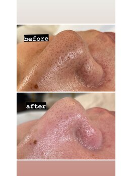 ルルン(LuLuN)/before→after