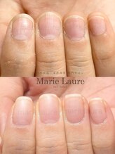 マリーロール 淀屋橋本店(Marie Laure)/自爪育成/深爪矯正/ネイルケア