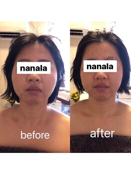 ナナラ(nanala)/小顔フェイシャル