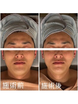 ビューティースタジオ ハンミ 福岡大名店(Beauty studio 韓美)/コルギ一回での効果