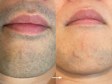 ヴィセラ(Vicella)/ヒゲ脱毛（2クール）