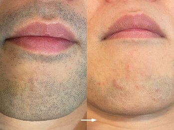 ヴィセラ(Vicella)/ヒゲ脱毛(2クール)