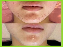 ヴィオール 名古屋栄店(VIOR)/《肌質改善》　ハーブピーリング