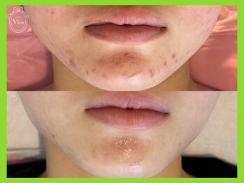 ヴィオール 名古屋栄店(VIOR)/《肌質改善》 ハーブピーリング