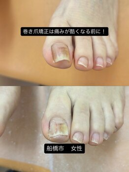 巻き爪じゅん 船橋店/巻き爪の痛みを我慢している方へ