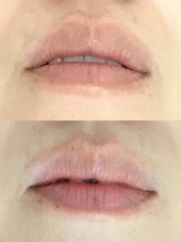 ドクターメラニン ラボ トーキョー 渋谷(Dr. Melanin Labo TOKYO)/唇メラニンケア症例
